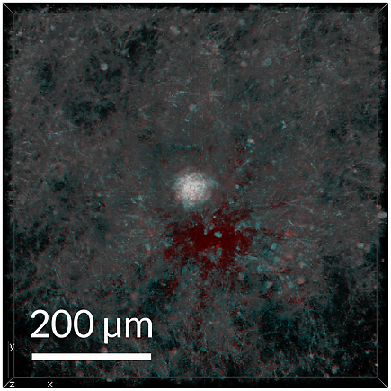 Red-blue anaglyph (for 3D glasses) image of before and after microcavitation in a fibrous collagen network