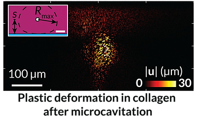 Plastic deformation in collagen after microcavitation